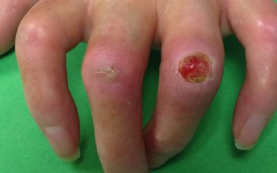 Systemische Sklerodermie: Ursachen, Diagnose, Verlauf und Therapie