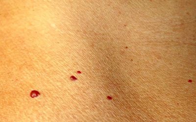 Tardive Hämangiome (Blutschwämmchen) – Ursachen und Therapie