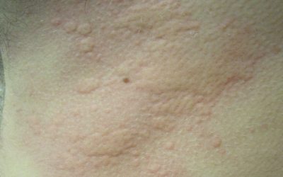 Urtikaria (Nesselsucht) – Ursachen, Symptome, Verlauf und Behandlung