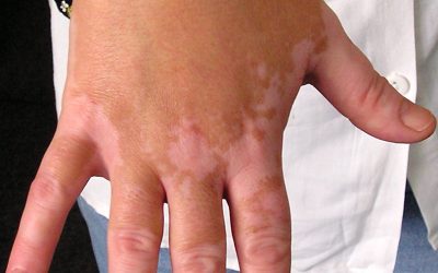 Vitiligo (Weißfleckenkrankheit) – Ursachen, Symptome, Verlauf & Therapie