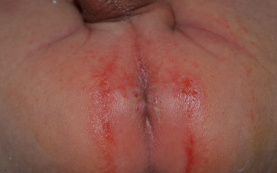 Windeldermatitis – Symptome und Behandlung