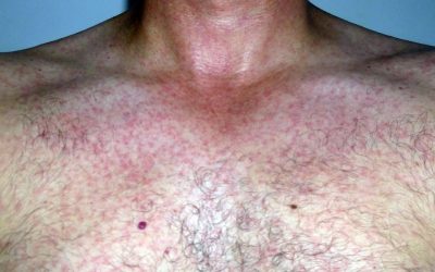 Hautausschlag beim Zika-Virus: Symptome und Behandlung