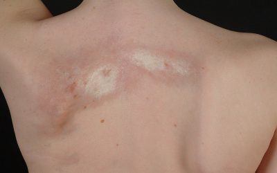 Zirkumskripte Sklerodermie (Morphea) – Ursachen, Symptome & Therapie