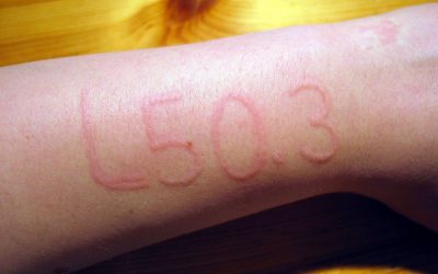 Dermographismus (Nesselsucht) – Ursachen, Online-Diagnose, Therapie