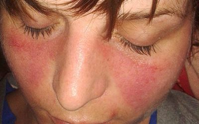 Kutaner Lupus erythematodes – Ursachen, Symptome und Therapien