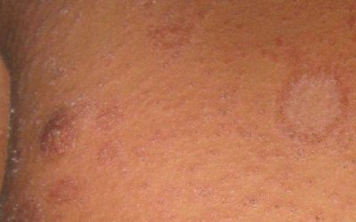 Röschenflechte (Pityriasis rosea) – Symptome und Therapie