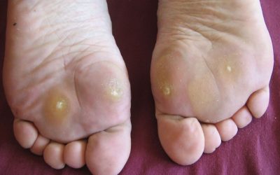 Warzen (Verrucae) – Arten, Symptome und Behandlung