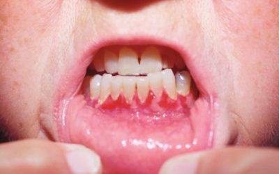 Pemphigus vulgaris: Ursachen, Symptome, Online-Diagnose & Therapie