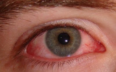 Bindehautentzündung: Ursachen, Aussehen, Online-Diagnose & Therapie