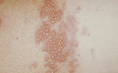 Blasen auf der Haut – Ursachen, Online-Diagnose & Therapie