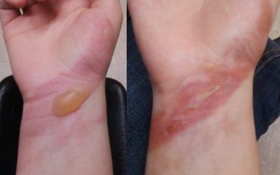 Verbrennungen der Haut – Verlauf, Symptome, Narbenbildung & Therapie