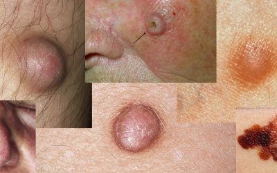 Hautkrebs erkennen: Bilder & Online-Diagnose durch Hautärzte