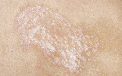 Lichen Sclerosus: Ursachen, Symptome, Online-Diagnose & Therapie