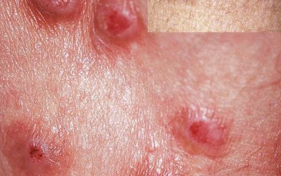 Prurigo nodularis: Ursachen, Aussehen, Online-Diagnose, Therapie