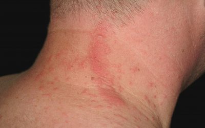 Raupendermatitis: Online-Diagnose & Therapie von Hautärzten