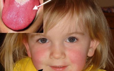 Scharlach: Ursachen, Symptome, Diagnose, Verlauf & Therapie