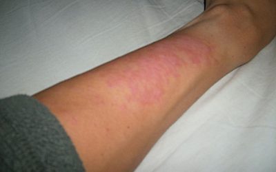 Sonnenallergie: Ursachen, Symptome, Online-Diagnose & Behandlung