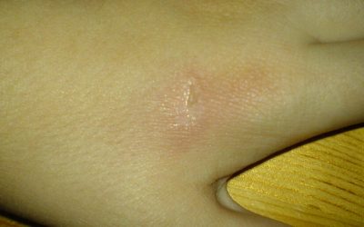 Verbrühungen der Haut – Verlauf, Symptome, Narbenbildung & Therapie