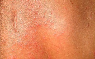 Whirlpool-Dermatitis – Ursachen & Online-Behandlung von Hautärzten