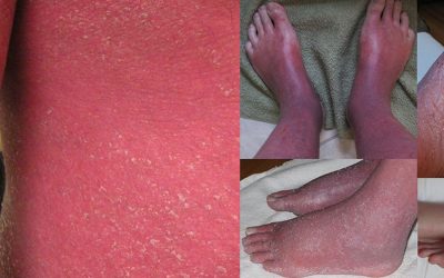 Gerötete Haut – Ursachen & Online-Diagnose von Hautärzten