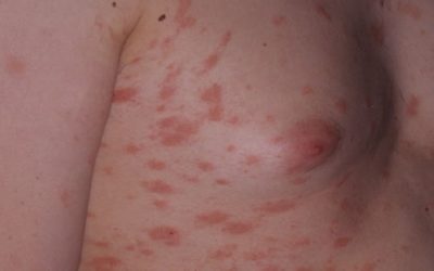 Juckender Hautausschlag: Ursachen, Online-Diagnose & Therapie