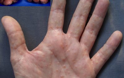 Handekzem: Ursachen, Online-Diagnose und Behandlung durch Hautärzte