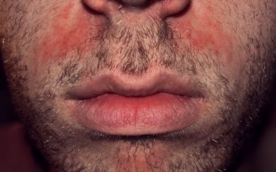 Hautausschlag im Gesicht – Ursachen, Online-Diagnose & Therapie
