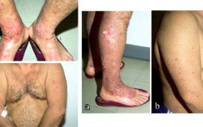 Knoten auf der Haut – Ursachen & Online-Diagnose