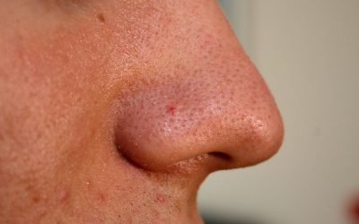 Pickel auf der Haut – Ursachen, Online-Diagnose, Therapie