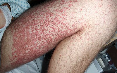 Purpura Schoenlein-Henoch: Symptome, Online-Diagnose, Behandlung