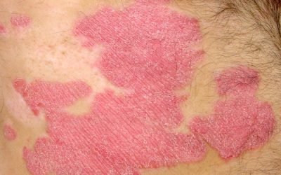 Rote Flecken auf der Haut – Ursachen, Online-Diagnose, Therapie