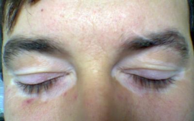 Weiße Flecken auf der Haut – Ursachen, Diagnose und Therapie